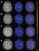 Fig. 1a-d: Glioblastoma