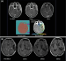 Fig. 2a-b: GBM patient