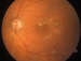 Abb. 2: Diabetische Retinopathie