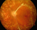 Abb. 3: Diabetische Retinopathie