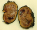 Aktuelles Bild - Abb. 2: Paragangliom-Harnblase