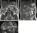Aktuelles Bild - Abb. 1a-c: Appendizitis-Diagnose