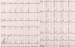 Abb. 1: Ruhe-EKG