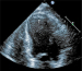 Abb. 2: Thrombus