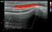 Abb. 3: Farbdoppler