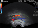 Abb. 3: Vense Thromboembolie