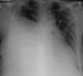 Abb. 1: Biphasisches Synovialsarkom