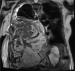 Abb. 3: Biphasisches Synovialsarkom