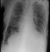 Aktuelles Bild - Abb. 4a: Biphasisches Synovialsarkom