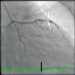 Aktuelles Bild - Abb. 3: NSTEMI