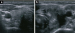 Abb. 1a-b: Thyreoiditis