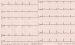 Abb. 2: EKG
