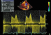 Abb. 4: CW-Doppler