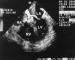Fig. 1: Sinus-Valsalvae-Aneurysma
