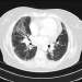Abb. 5: Alveolitis