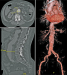 Abb. 1: Aortenaneurysma