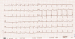 Abb. 2: EKG