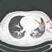 Abb. 3: CT-Thorax