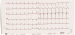 Abb. 5: EKG