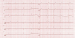 Abb. 10: EKG