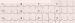Abb. 1: EKG