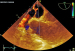 Abb. 3: Vorhofseptumaneurysma
