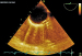 Abb. 6: Plaque  - Aorta