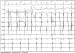 Abb. 1: EKG