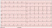 Aktuelles Bild - Abb. 1: EKG