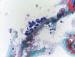 Aktuelles Bild - Abb. 1: Urothelkarzinom