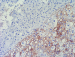 Aktuelles Bild - Abb. 1: Nierenzellkarzinom-Pathologie