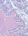 Abb. 2: Nierenzellkarzinom-Pathologie