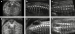 Abb. 1a-f: Spina bifida  Prnataldiagnose