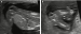 Aktuelles Bild - Abb. 3a-b: Spina bifida  Prnataldiagnose