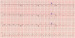 Aktuelles Bild - Abb. 1: EKG