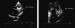 Fig. 2: Echokardiographie - Linksatriale Thromben