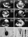 Fig. 1A-H: Thrombus - Filter