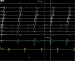 Abb. 3: Mikro-Reentry