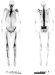 Abb. 1: Hypertrophe pulmonale Osteoarthropathie