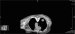 Abb. 2: Hypertrophe pulmonale Osteoarthropathie