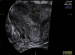 Abb. 1: Uterus subseptus