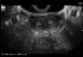 Abb. 3: Uterus subseptus