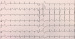 Aktuelles Bild - Abb. 1: EKG