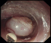 Abb. 3: Subepithelialer Tumor