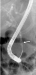 Abb. 3B: Choledochuskonkrement