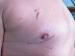Abb. 1: Mitralklappenchirurgie