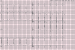 Abb. 1: EKG