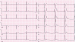 Abb. 1: EKG