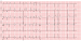 Abb. 1: EKG