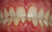 Abb. 1: Schwangerschaftsgingivitis